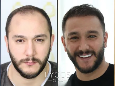Hair Transplant Before – After 2