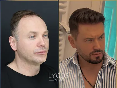 Hair Transplant Before - After 4