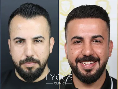 Hair Transplant Before – After