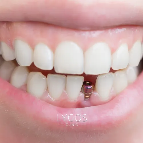 Dental Implant Treatments 2