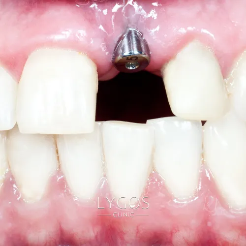 Dental Implant Treatments 3