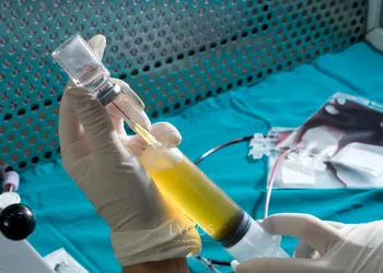Saç Dökülmesi Tedavileri 5 Stem Cell Therapy