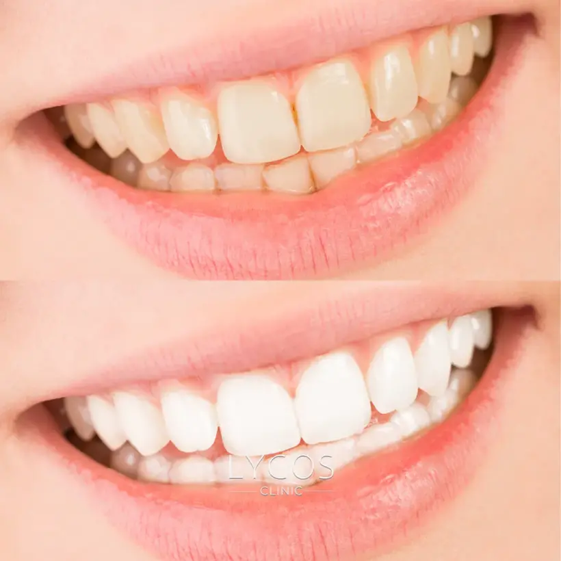 Galeri 55 Teeth Whitening Five