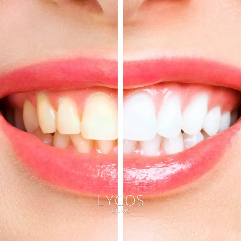 Galeri 57 Teeth Whitening Four
