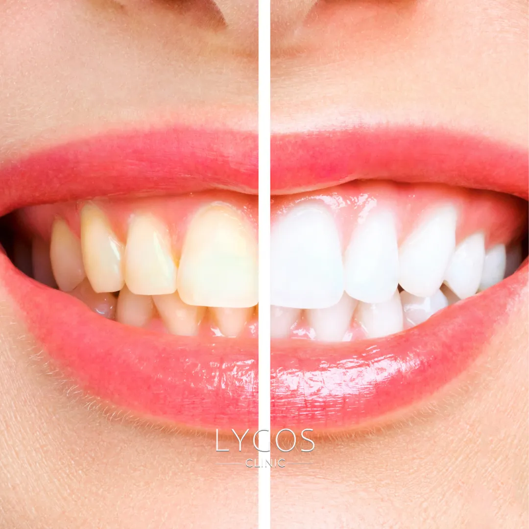 Teeth Whitening Four