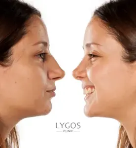 Galeri 44 What is Rhinoplasty?