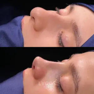 Galeri 45 rhinoplasty-results-in-turkey.webp