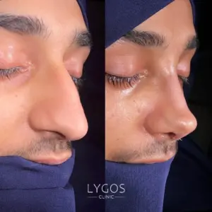 Galeri 43 Rhinoplasty Surgery For M en