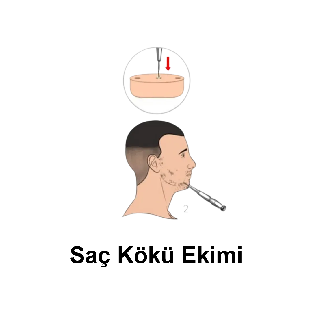 Saç Kökü Ekimi