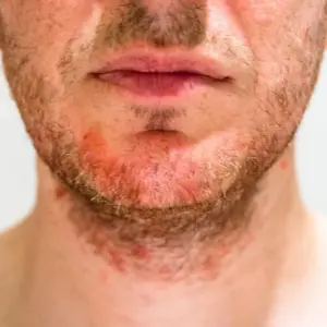 Sakal Ekimi 25 effective strategies for alleviating beard itch