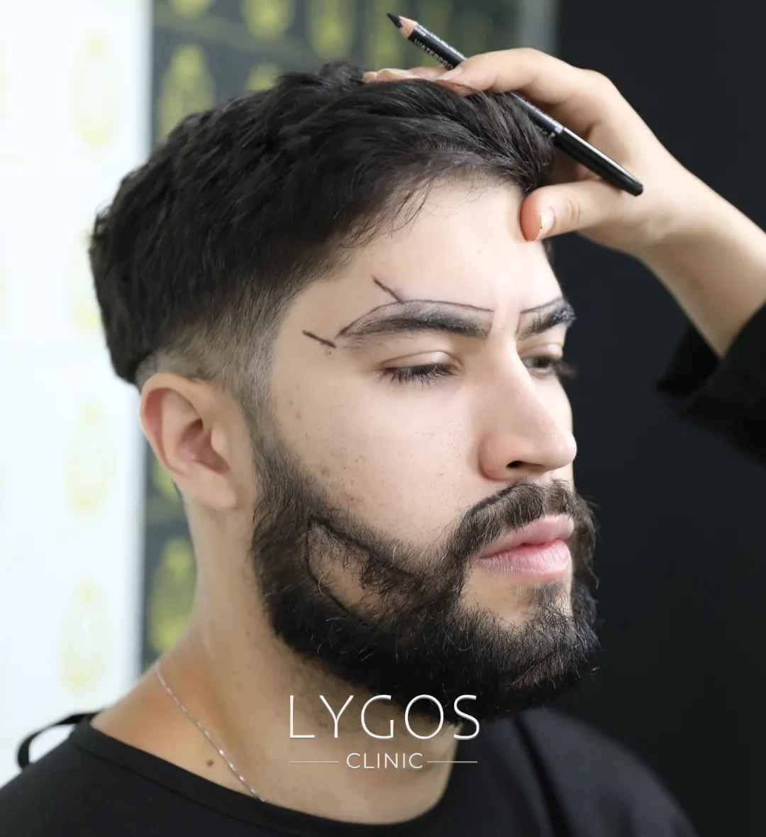 Kaş Ekimi Lygos 11 fue eyebrow transplant advantages 1 e1743750318177