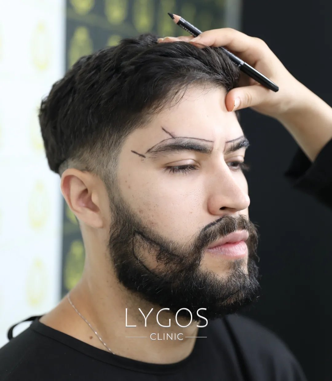 Kaş Ekimi Lygos 2 FUE Eyebrow Transplant