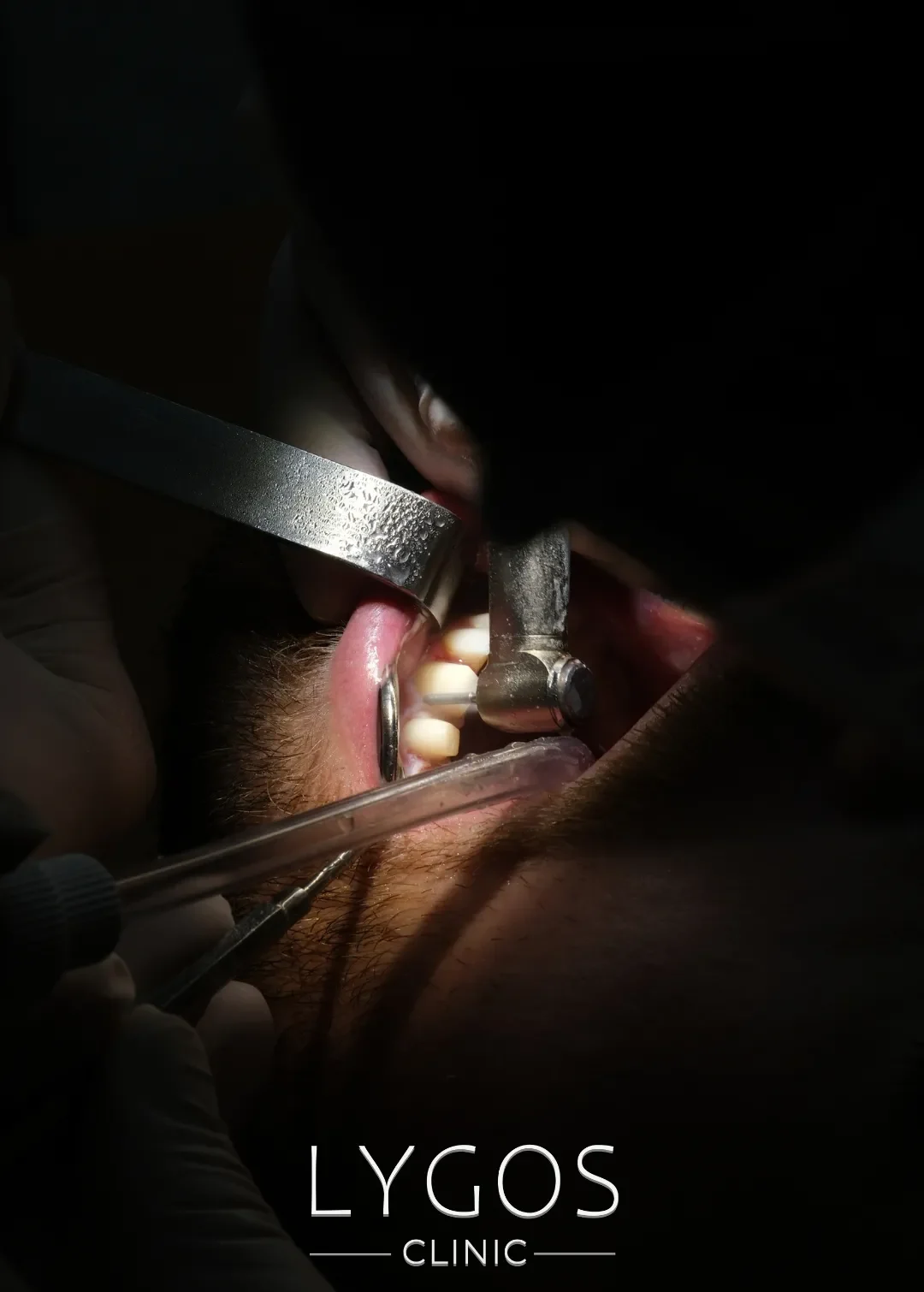 Zirconium Veneer 12 How is Zirconium Veneer Done