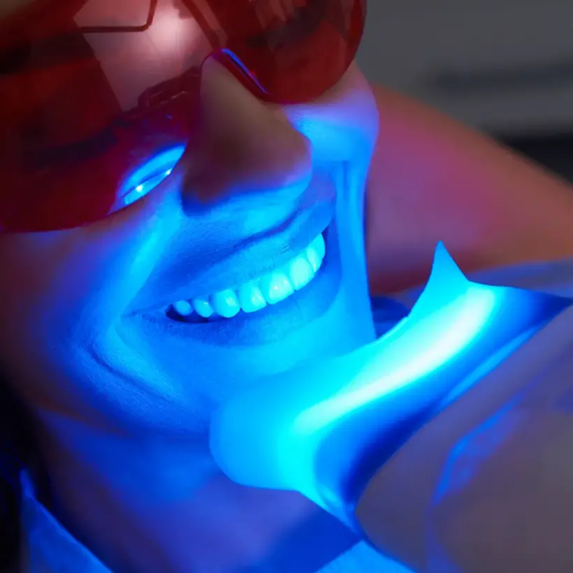 Galeri 56 Teeth Whitening1