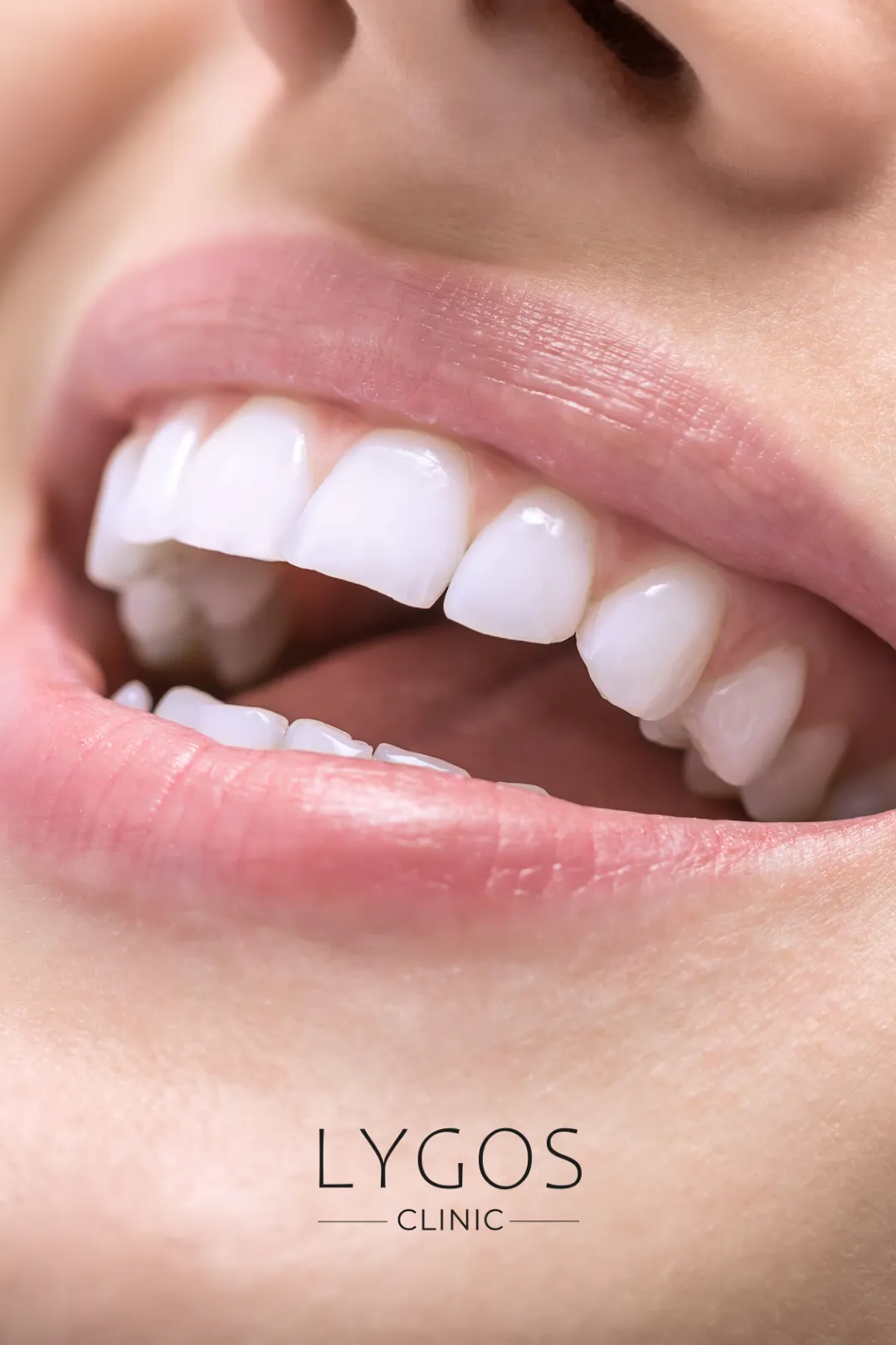 Hollywood Gülüşü 32 What is Hollywood Smile