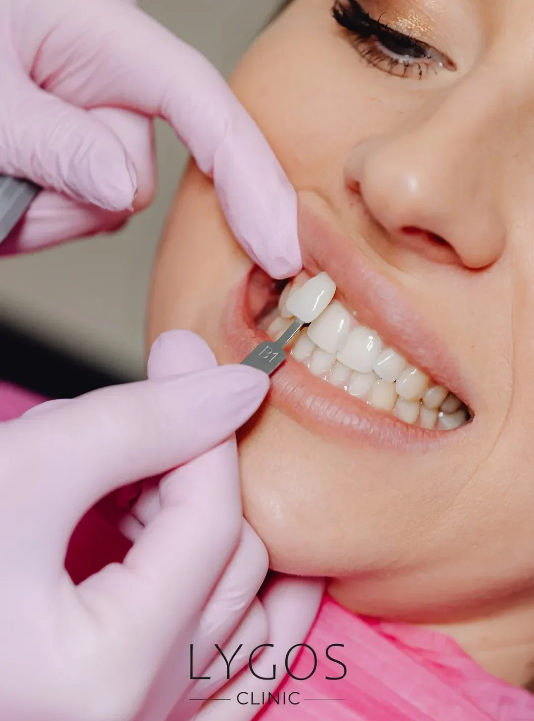 Zirconium Veneer 11 What is Zirconium Veneer