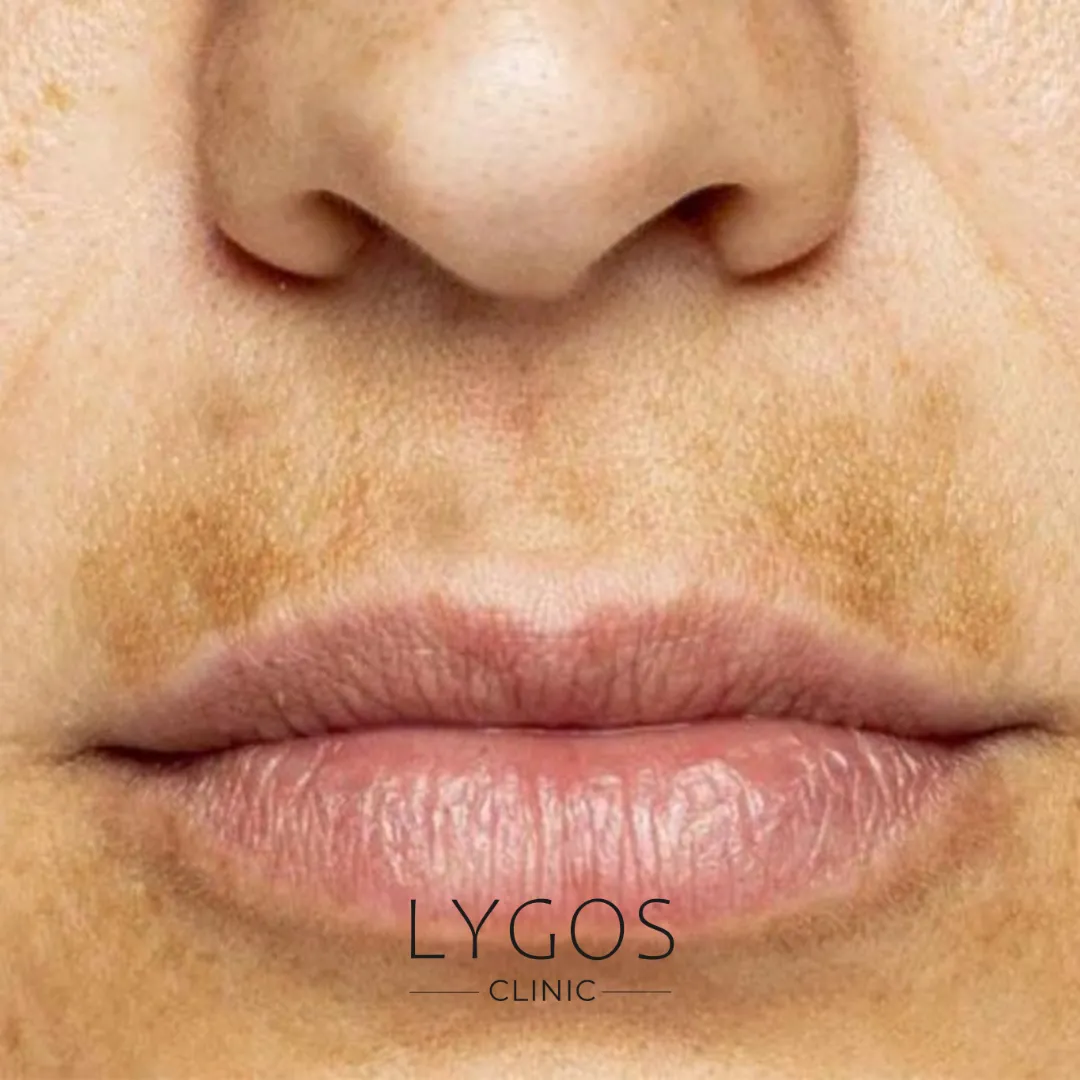 How to Get Rid of Mustache Area Darkening? 1 Bıyık Bölgesi Kararması Nasıl Geçer