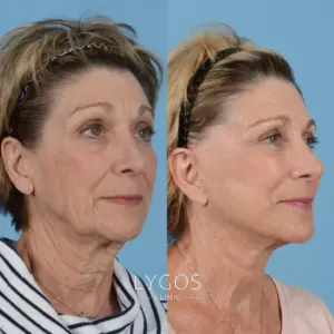 Galeri 46 Yüz Germe Before After 1
