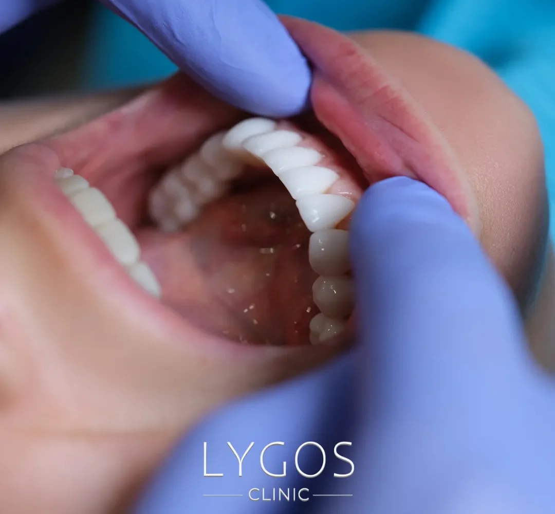 Zirconium Veneer 13 Zirkonyum Kaplama Diş Eti Çekilmesi