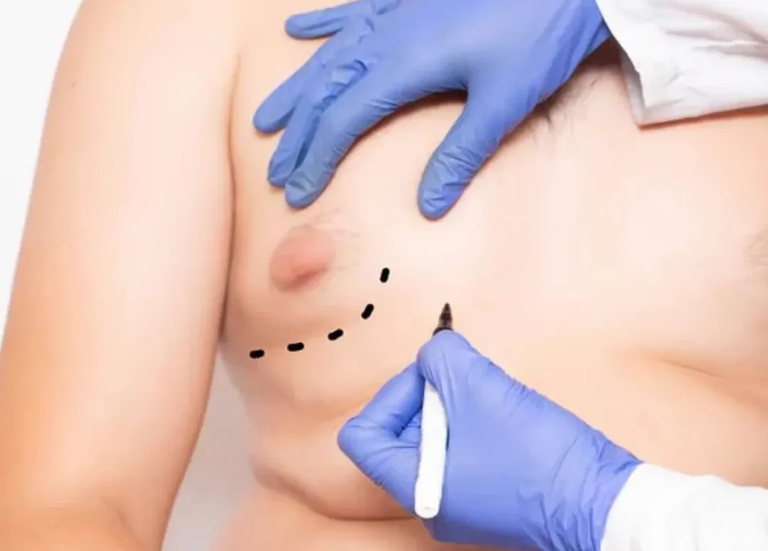 Gynecomastia 11 jinekomasty tedavi edilmezse ne olur?