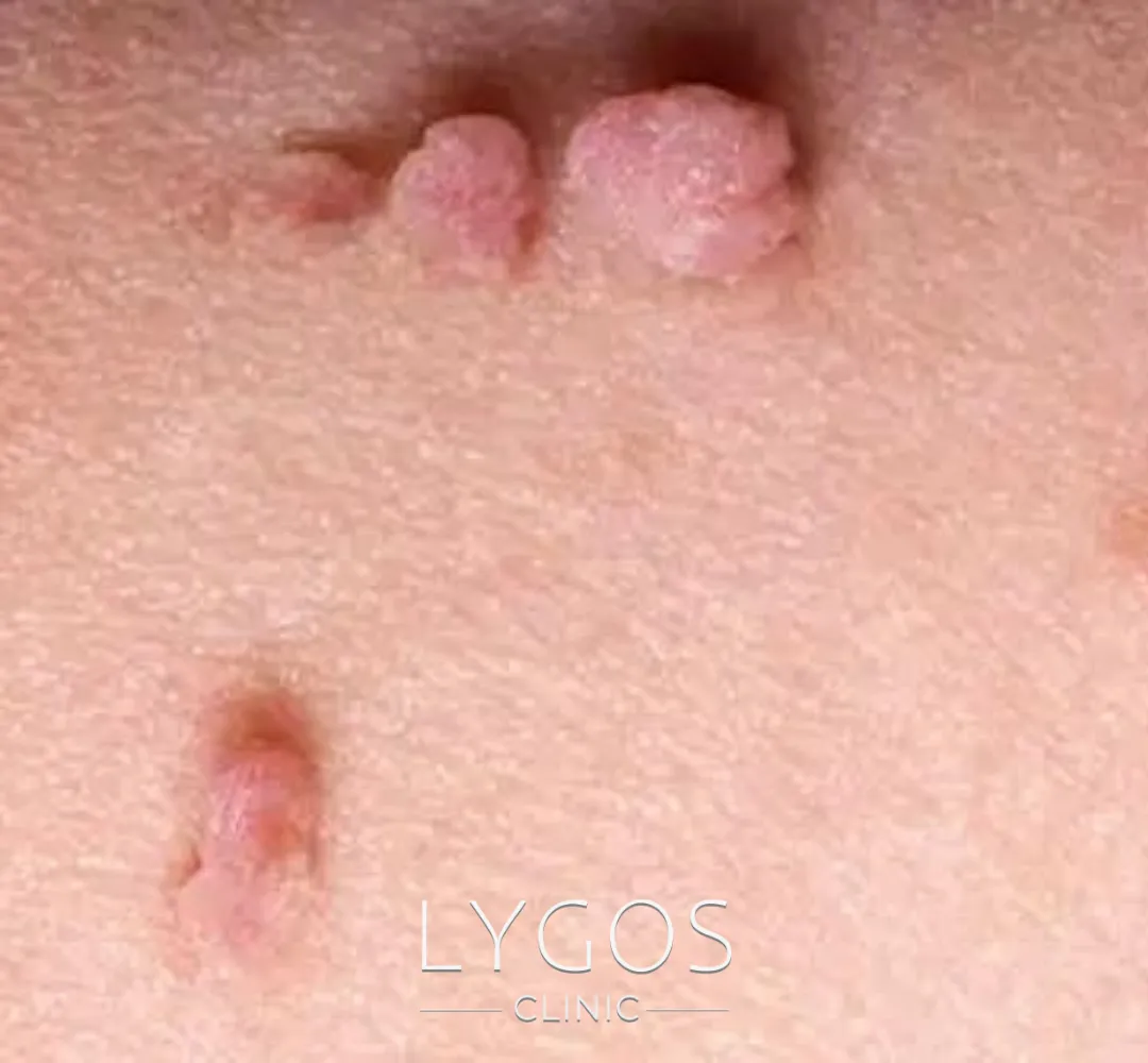 Genital Siğil Nasıl Bulaşır?