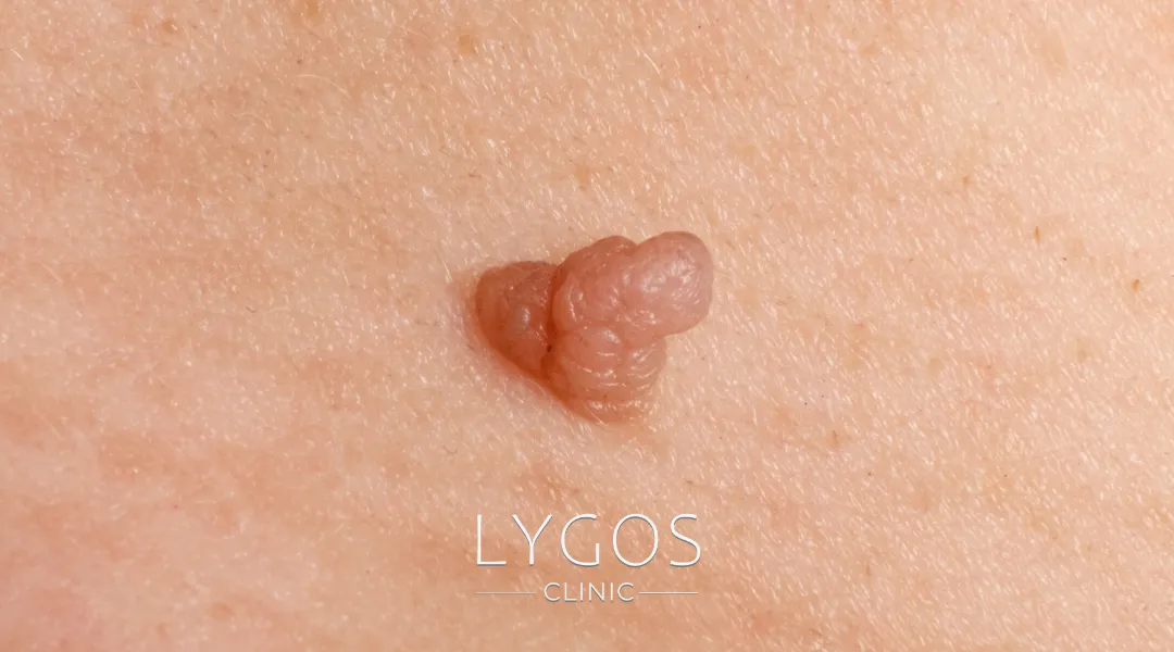 Genital Siğil Nedir?