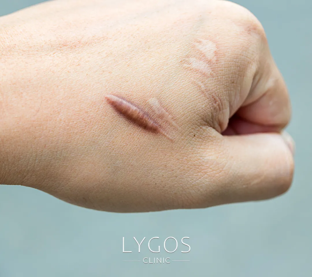 Keloid Treatment 11 Keloid skar nedir ?