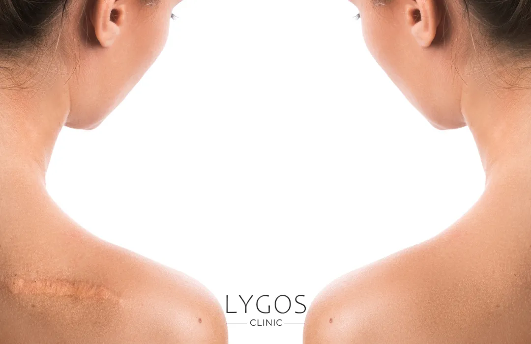 Keloid Treatment 20 Keloid tedavisi öncesi sonrası