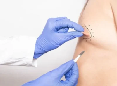Gynecomastia 12 yalancı jinekomasty nedir?