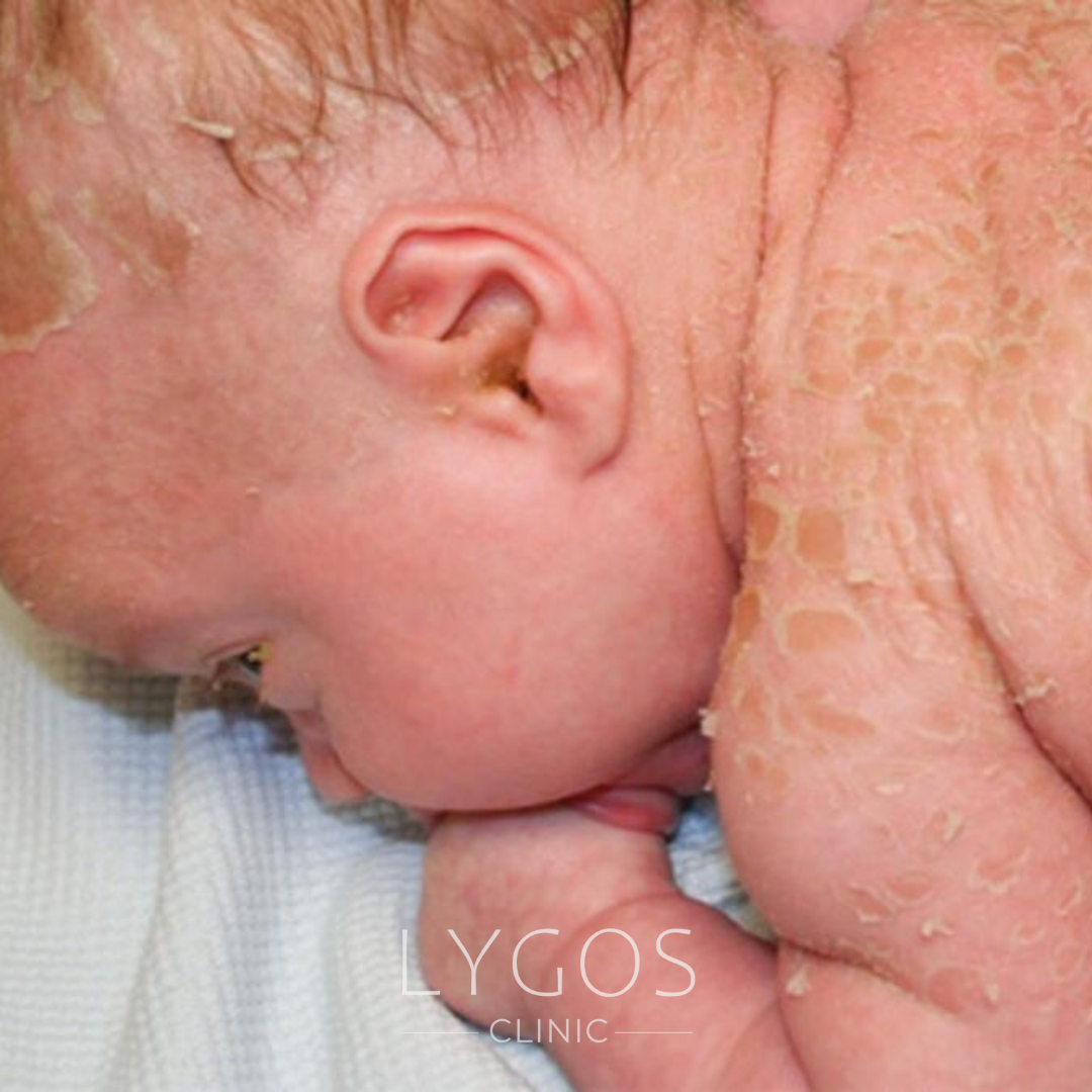 Harlequin Ichthyosis | Clown Baby Syndrome 1 Harlequin Sendromu