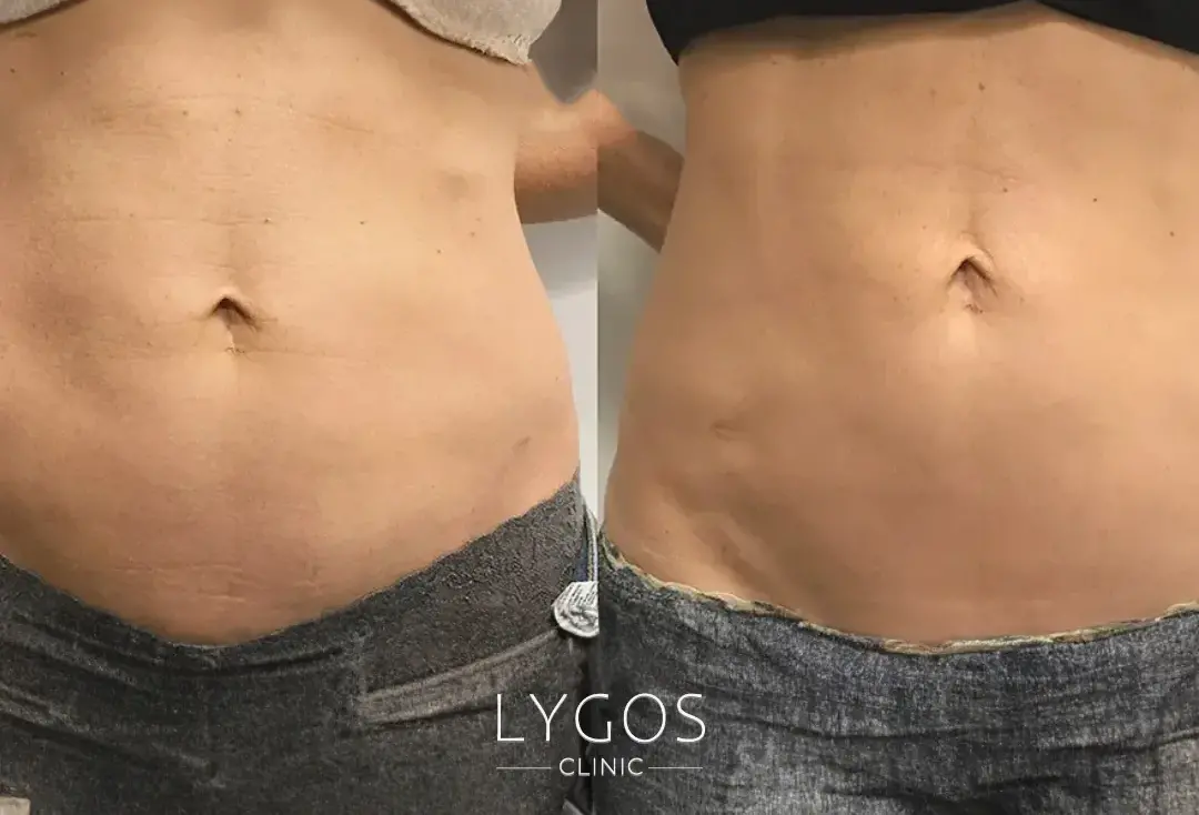 Velashape 3 12 Velashape 3 uygulama öncesi ve sonrası