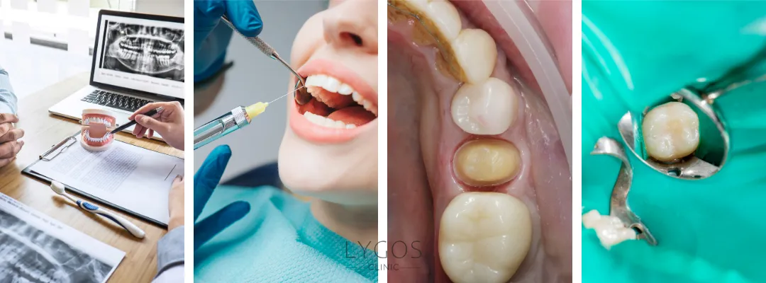 Composite Filling Procedure