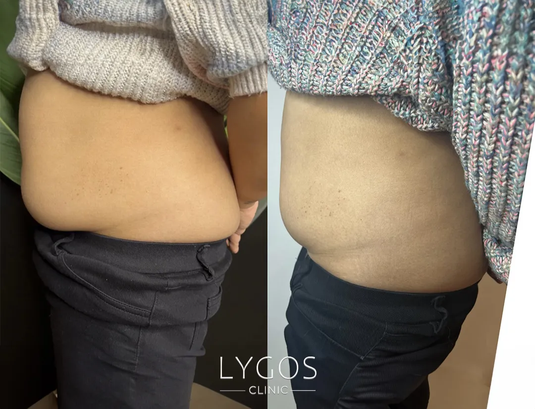 Cryo Cold Lipolysis 18 Cryo soğuk lipoliz öncesi ve sonrası