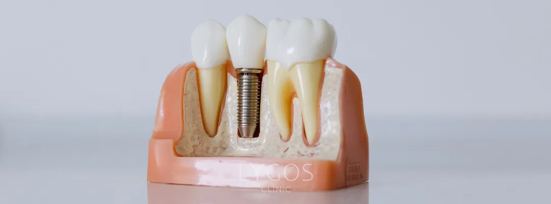 What are dental implants?