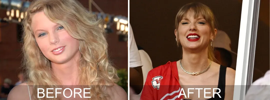 Diş Kaplaması Öncesi ve Sonrası Taylor Swift