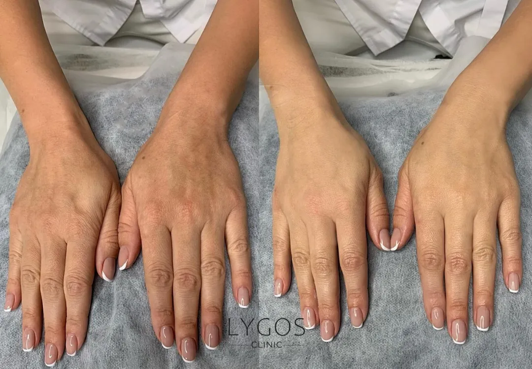 Hand Mesotherapy 13 El Mezoterapisi Öncesi ve Sonrası