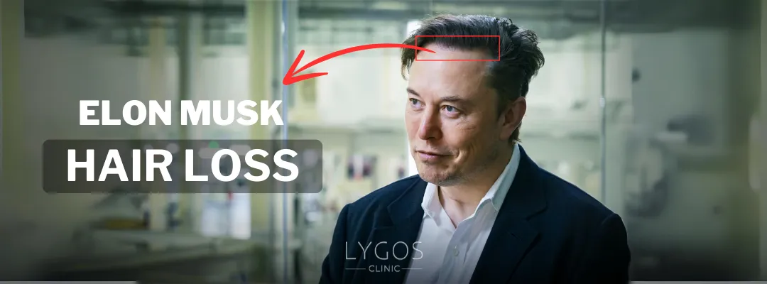 Elon Musk Hair Loss