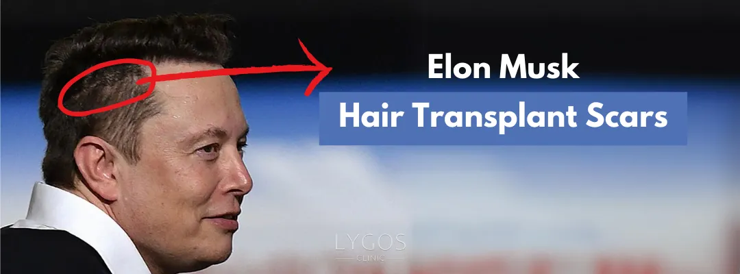 Elon Musk Hair Transplant Scars