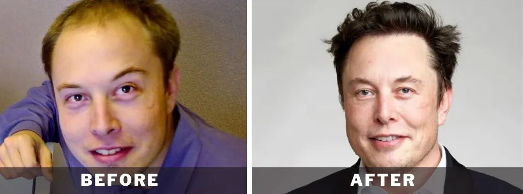 Elon Musk Hair Transplant Before and After