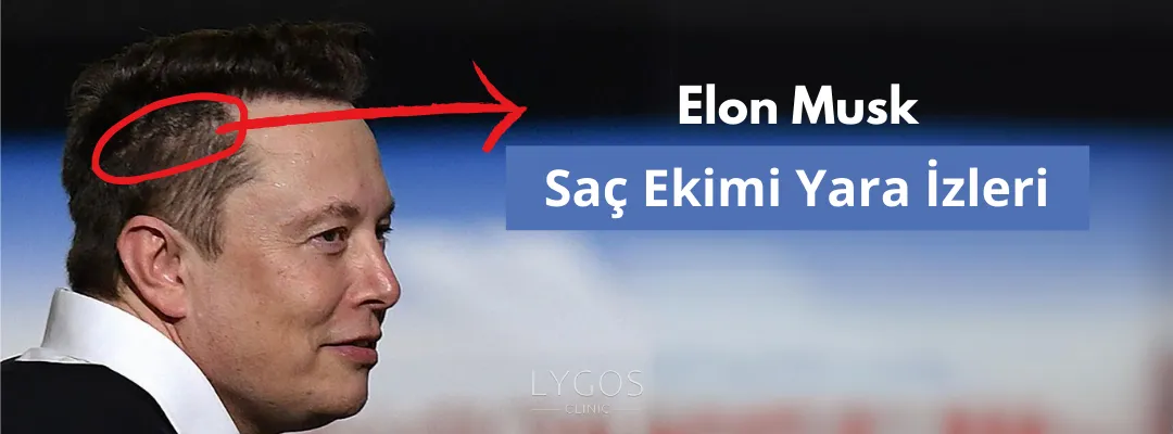 Elon Musk Saç Ekimi Yara İzleri