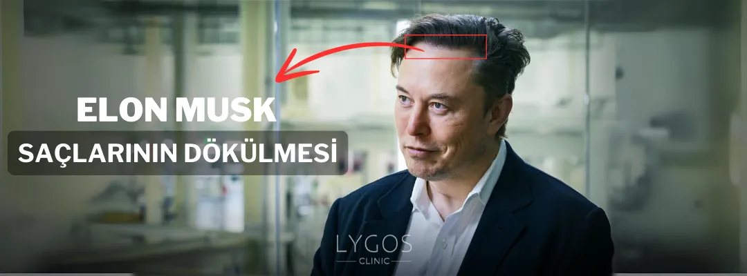 Elon Musk'ın Saçlarının Dökülmesi