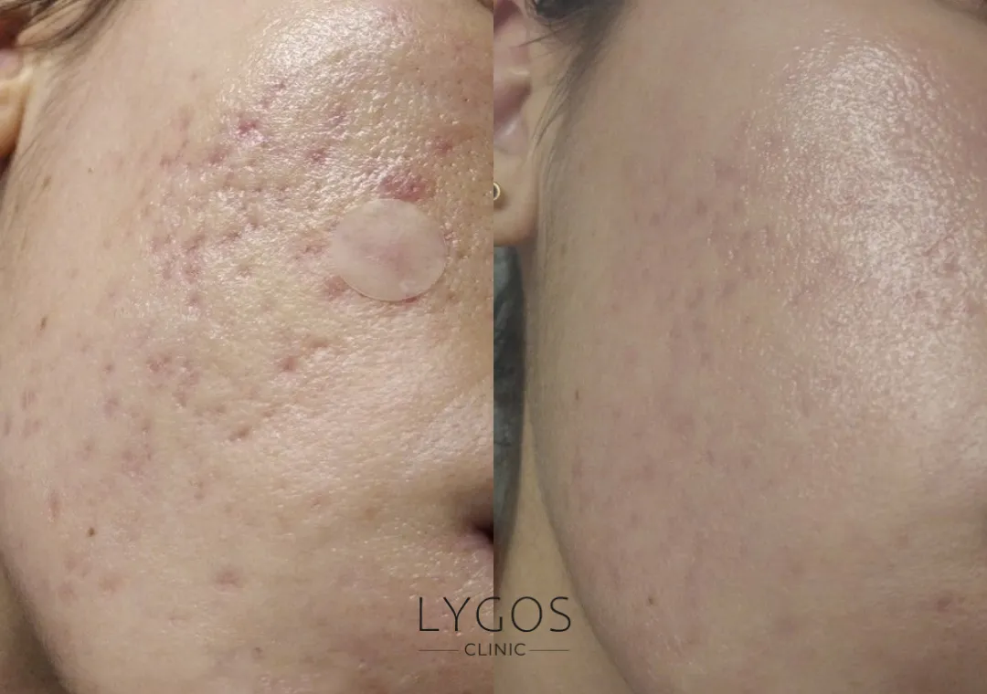 Fractional Co2 Laser 13 Fraksiyonel Co2 Lazer Öncesi ve Sonrası