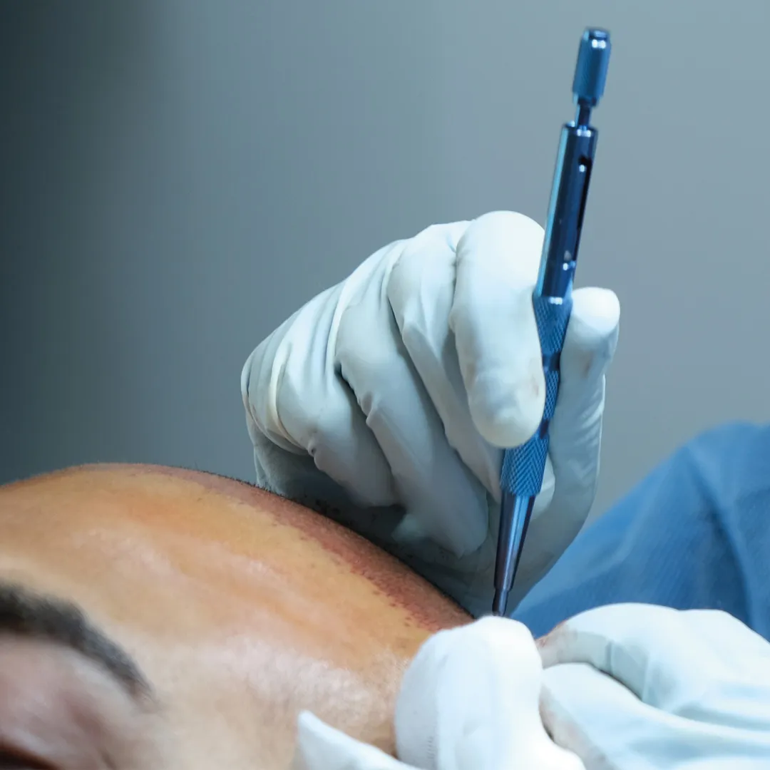 FUT vs. FUE Hair Transplant Techniques | LYGOS CLINIC 2025 1 FUE vs. FUT saç ekimi: En iyi saç ekim yöntemi hangisidir?