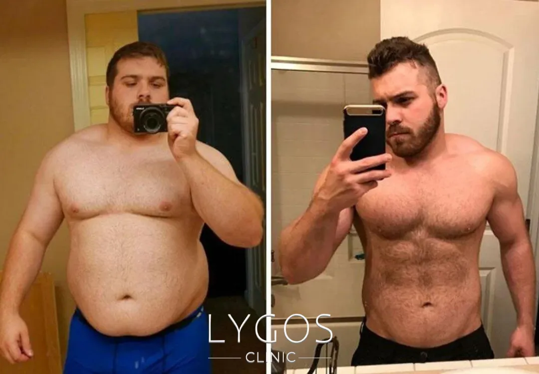 Gastrik Bypass Ameliyatı 27 Gastrik Bypass Ameliyatı Öncesi ve Sonrası