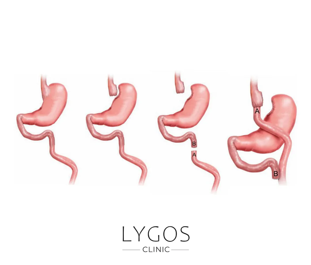 Gastrik Bypass Ameliyatı 11 Gastrik Bypass Nasıl Yapılır