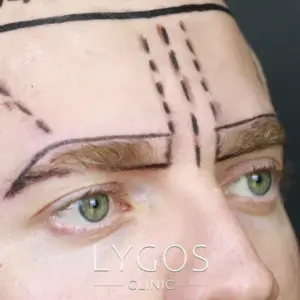 Eyebrow Transplant 22 Kaş Ekimi Tedavisi Süreci Kaş Ekimi Avantajları Nelerdir