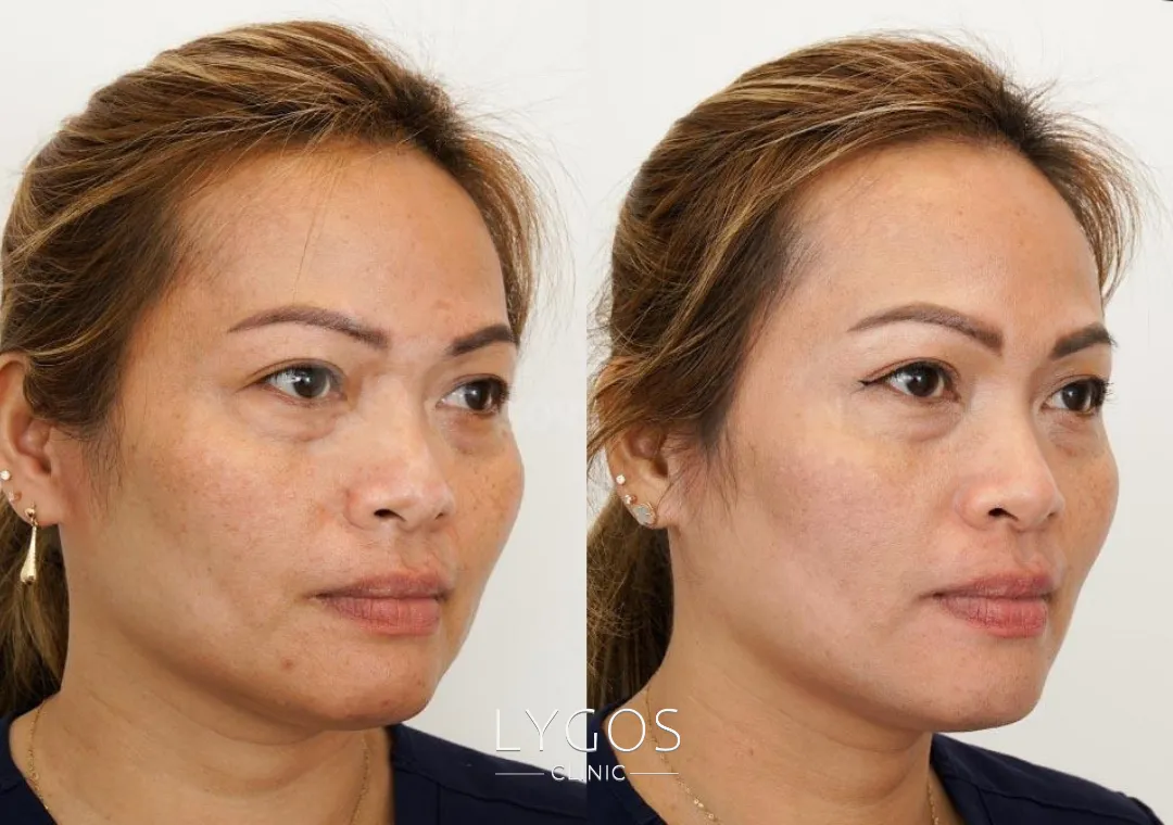 Lazer Toning 14 Lazer toning öncesi ve sonrası