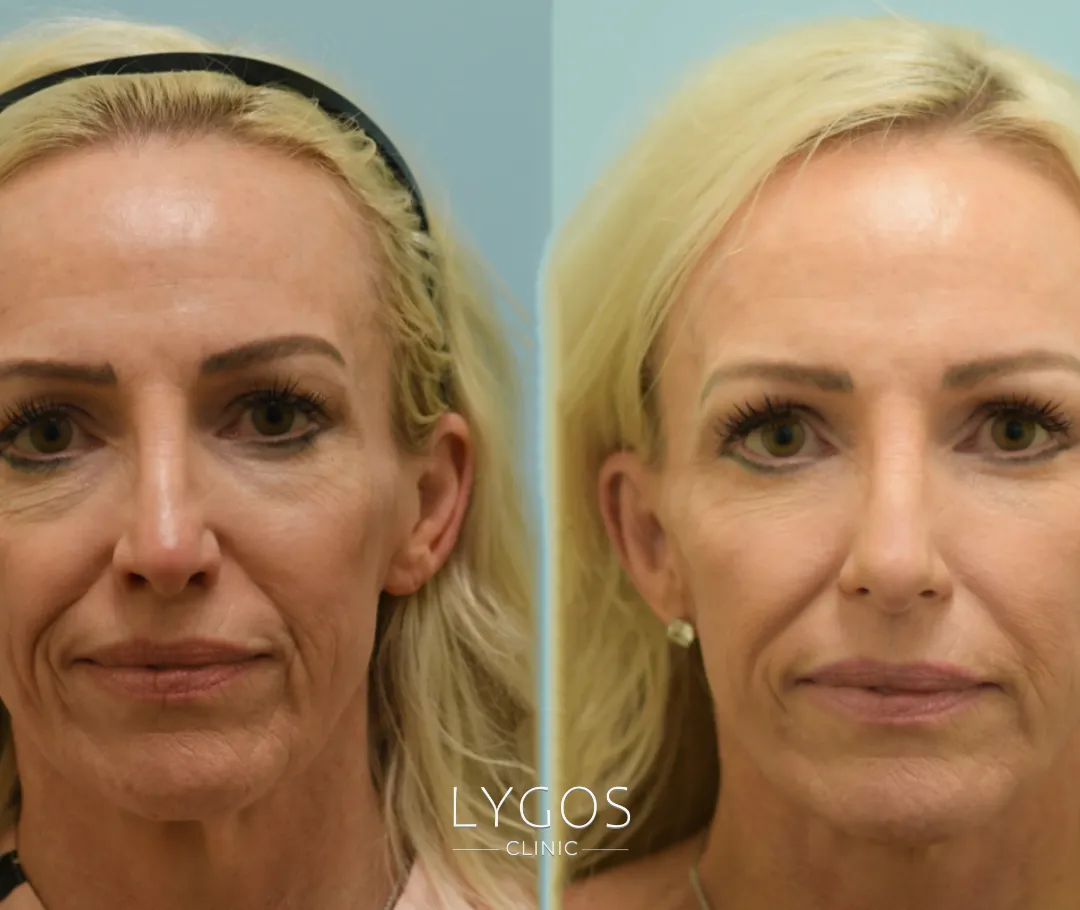 Mesobotox 16 Mezobotoks Öncesi ve Sonrası