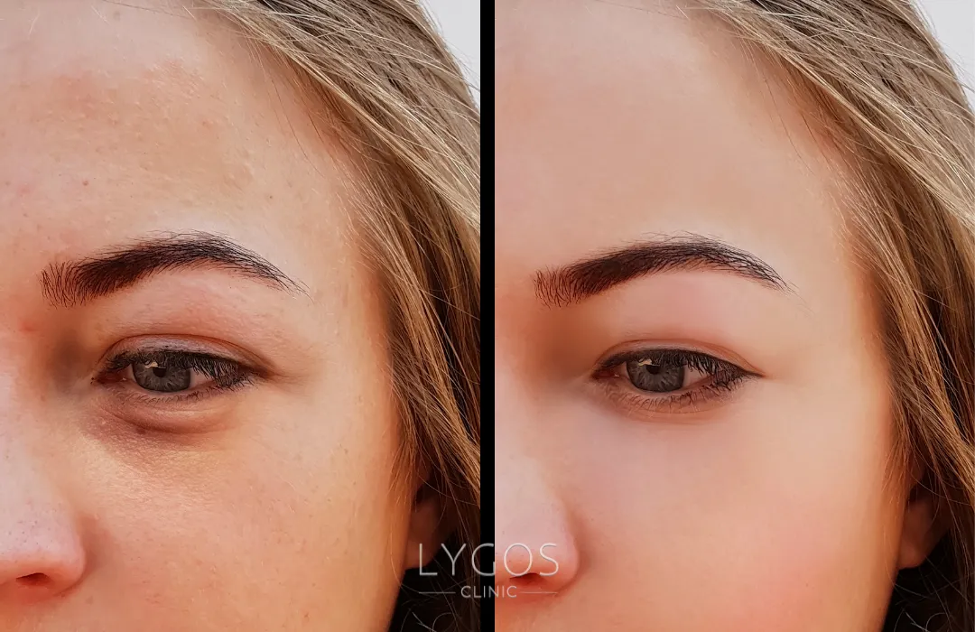 Otolog Biyostimülan Dolgu 18 Otolog Biyostimülan Dolgu Öncesi ve Sonrası