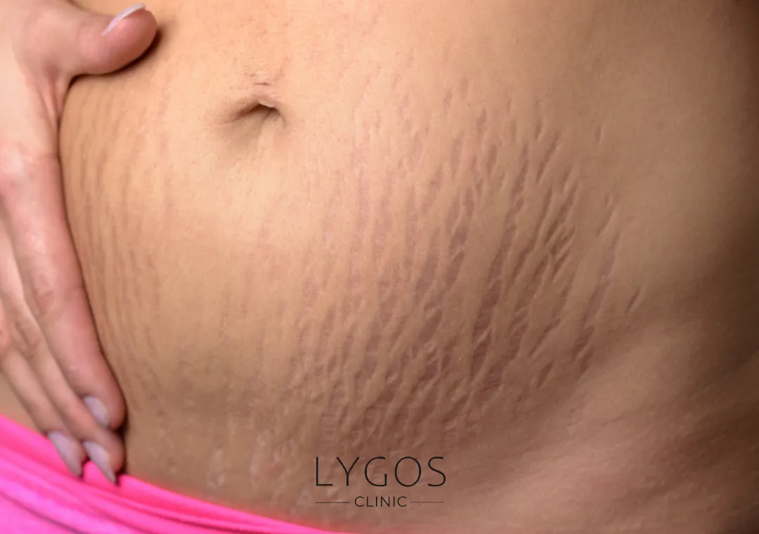 Velashape 3 11 Velashape 3 nasıl yapılır?
